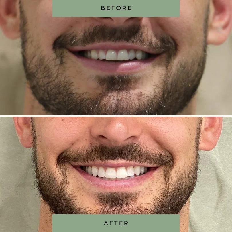 Adult-orthodontic-treatment29