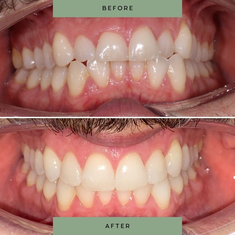 Adult-orthodontic-treatment30