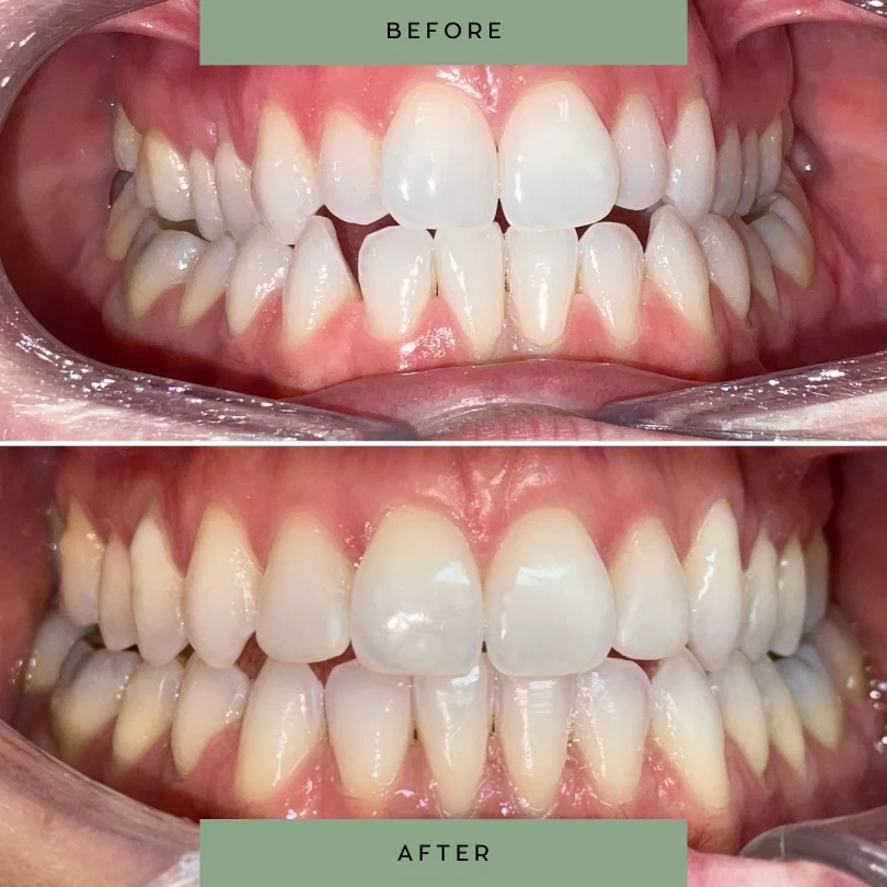 Adult-orthodontic-treatment34