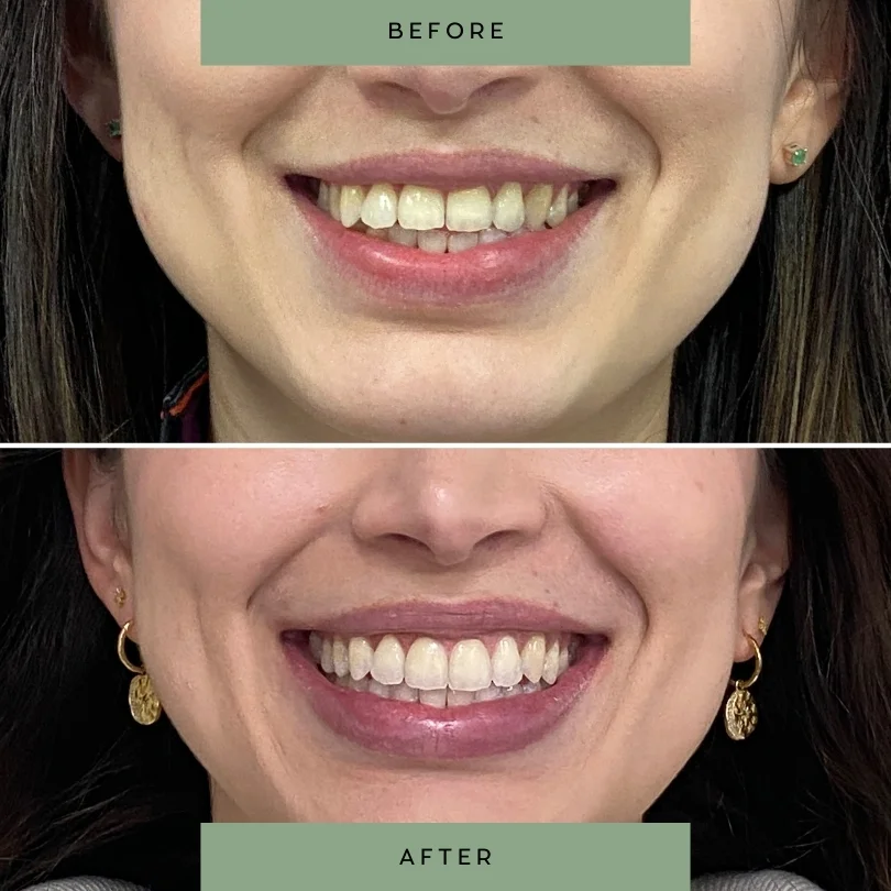 Adult-orthodontic-treatment37