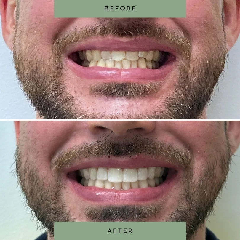 Adult-orthodontic-treatment41