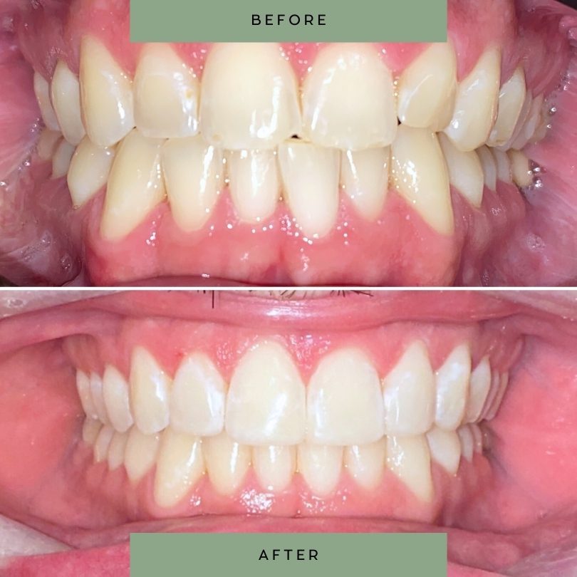 Adult-orthodontic-treatment42