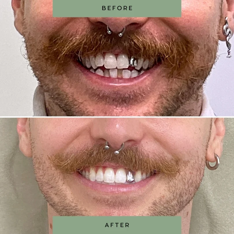 Adult-orthodontic-treatment57