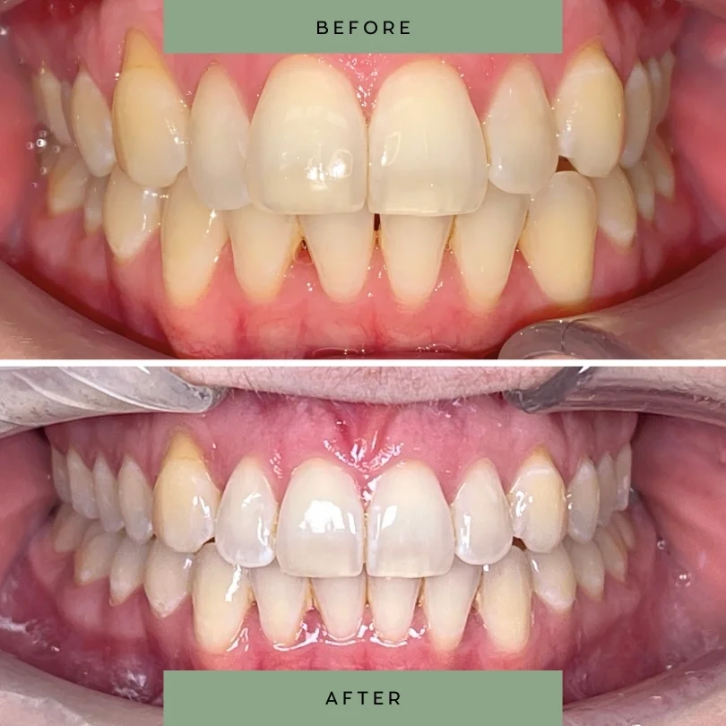 Adult-orthodontic-treatment96