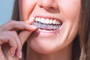 Clear Aligners in Dural
